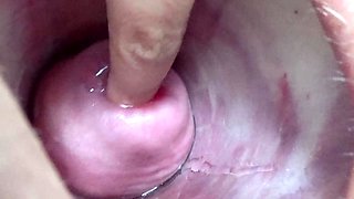 Extreme Cervix Playing with Insertion Metal Chain in Uterus